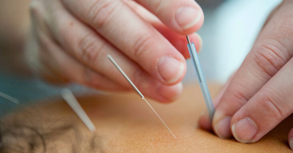 針灸能引起大腦特殊變化